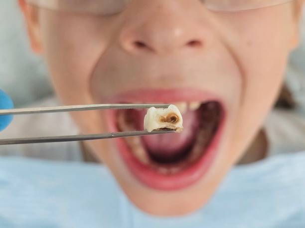 Best Emergency Dental Care for Broken or Chipped Teeth in Fort Mill, SC
