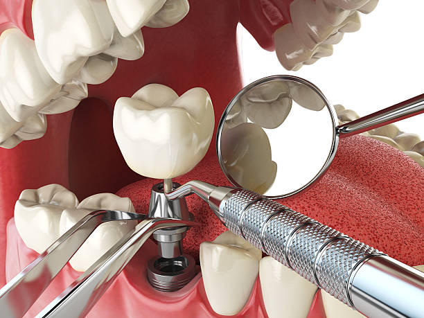 Best Emergency Gum Treatment in Fort Mill, SC