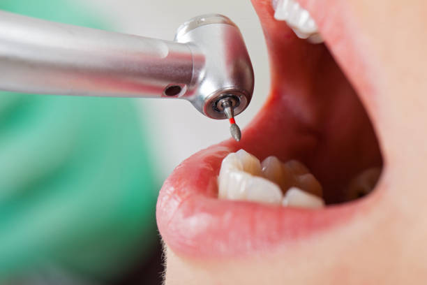Best Emergency Wisdom Teeth Removal in Fort Mill, SC